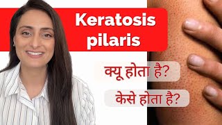 Keratosis Pilaris Treatment  Causes  Precautions  How to improve  Dermatologist recommends [upl. by Babara]