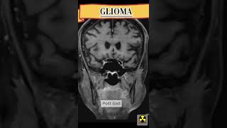 MRI Brain  GLIOMA mriscan medicalimaging See description [upl. by Dorsy]