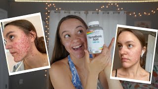 I TOOK PANTOTHENIC ACID FOR 2 MONTHS  Pantothenic Acid B5 For Acne [upl. by Leonora]