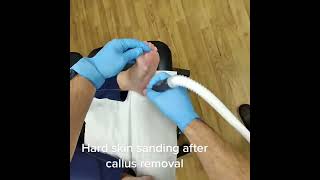 Unveiling smooth feet postscalpel Podiatrist magic – Hard skin sanding PodiatryWin FootCare [upl. by Estren]