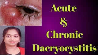 Dacryocystitis  Acute dacryocystitis Chronic Dacryocystitis Stages of Dcryocystitis Mucocele [upl. by Lectra]