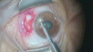 Pterygium surgery  Fibrin Glue [upl. by Lainey147]