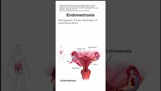 Endometriosis [upl. by Loredo701]