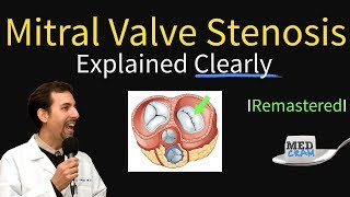 Mitral Valve Stenosis Diagnosis Treatment Pathophysiology [upl. by Notsirk]