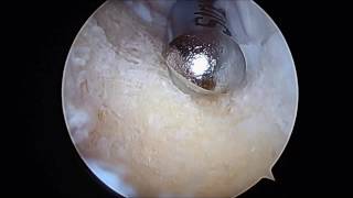 Calcaneoplasty Arthroscopic Surgery for Removal Haglunds Deformity for Heel Pain SFISM [upl. by Solraced]