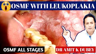 OSMF Greads। OSMF with LEUKOPLAKIA। its Treatment 😱🥴🥴 [upl. by Mahalia]