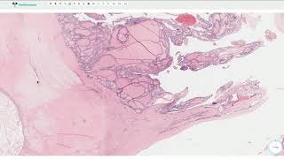 Multinodular Goiter  Thyroid Gland Histopathology [upl. by Nueormahc]