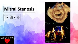 Mitral Stenosis [upl. by Che]