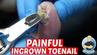 EXTREME PAINFUL INGROWN TOENAIL REMOVALDID IT HURT TO REMOVE IT [upl. by Nyrret251]