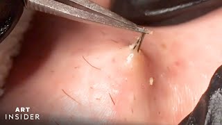 How Ingrown Hairs Are Removed  Art Insider [upl. by Ahsoj800]