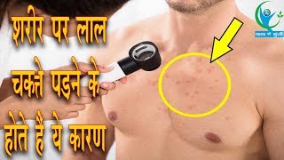 चेहरे पर लाल चकत्ते पड़ने के होते हैं ये कारण  Home Remedies For Rashes [upl. by Webb]