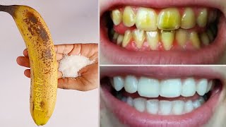 Easy teeth whitening at home in 2 minutes  Remedy to whiten teeth at home white teeth works 100 [upl. by Ashlan516]