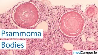 Psammoma bodies  Pathological bodies [upl. by Carmelita86]