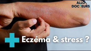 Eczéma  quelles solutions   Allo Docteurs [upl. by Letta]