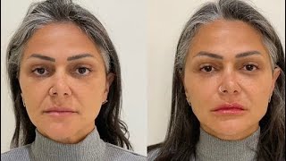 Antes e depois harmonização facial [upl. by Saihttam]