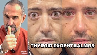 Thyroid exophthalmos in young man [upl. by Ataeb412]