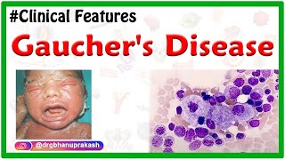 Gauchers Disease Etiology Types Clinical Features Pathogenesis Diagnosis and Treatment [upl. by Anahir551]