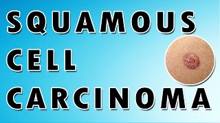 Squamous Cell Carcinoma [upl. by Toy]