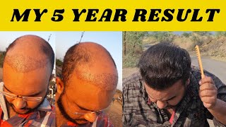 HOW HAIR TRANSPLANT LOOKS AFTER 5 YEARS  tannudada [upl. by Vachill]