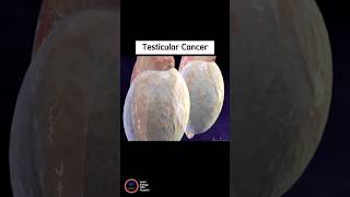 Testicular Cancer [upl. by Asila]