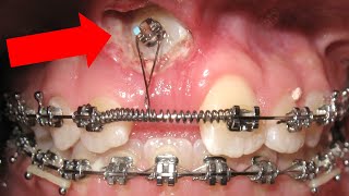 🔥Unexpected orthodontic impaction🔥 and OPEN BITE timelapse HOW BRACES WORK [upl. by Nogras]