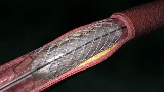 Angioplastia de arteria coronaria Vía radial [upl. by Alyworth18]