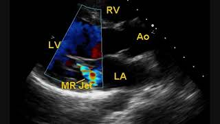 Post BMV Echocardiogram [upl. by Dorreg]