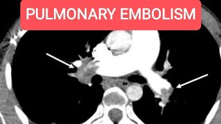 Pulmonary Embolism with multiple hepatic metastasis  CT Chest with Whole Abdomen [upl. by Koziel]