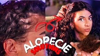 ALOPECIE LES SOLUTIONS NATURELLES [upl. by Robby]