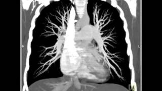 Lung Anatomy Pulmonary Embolism MIP [upl. by Edualcnaej]