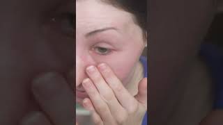 आँखों के निचे सूजन होना  Swelling under eyes Homeopathy Treatment  Garhwal Homeopathy  shorts [upl. by Eloise]