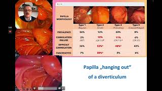 ERCP  Precut Sphincterotomy Using the Huibregtse Needle KnifeBiliary Catheter [upl. by Michele948]