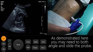 Ultrasound Tutorial Kidney amp Bladder  Urinary Tract  Radiology Nation [upl. by Mignon]