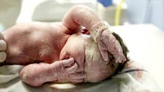 Vernix Caseosa What is it [upl. by Darnell205]