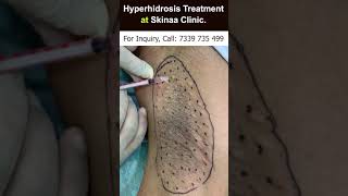 Hyperhidrosis Treatment at Skinaa Clinic  Viral shorts [upl. by Gibeon182]