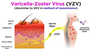 Chickenpox and Shingles VaricellaZoster Virus [upl. by Alten433]