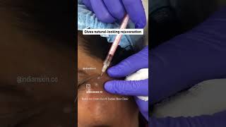 Botox for crows feet  treatment for wrinkles around eyes botox crowsfeet nagpurskinclinic [upl. by Daveda]