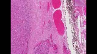 Histopathology ThyroidFollicular carcinoma [upl. by Winnick]