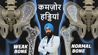 WEAK BONES  Reason to Remedy  OSTEOPOROSIS  DrEducation Hindi  Eng Subs [upl. by Htez]