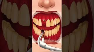 ASMR TEETH  HOW TO FIX DENTAL PROSTHESIS  TREATMENT OF FIXED DENTAL PROSTHESIS  shorts asmr [upl. by Fiske825]