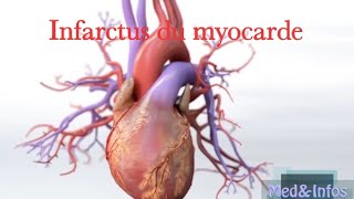 Infarctus du myocardemyocardial infarction [upl. by Hermie348]