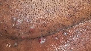 Satisfying Ingrown Hair Removal Back of head  Pt 3 [upl. by Toni797]