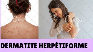 Dermatite Herpétiforme [upl. by Komarek]