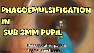 intraoperative miosis  phacoemulsification through small pupil  patience can give you rewards [upl. by Kalle]