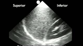 Video procedurale Rilevazione del liquido pleurico con ecografia [upl. by Valma561]