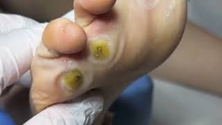 Pedicure video30，vertical plantaris，plantar wart [upl. by Odnarb781]