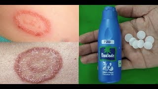 दाद खाज खुजली की 2 मिनट में छुट्टी कर देगा  fungal infection treatment at home  dad khaj ka ilaj [upl. by Groot230]