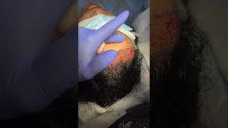 Female Hair Transplant  shorts ytshorts thetransplanttruth [upl. by Perni]