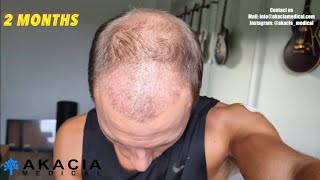 Hair Transplant Growth Timeline  the first 3 months [upl. by Annailuj997]