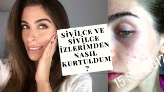 SİVİLCE VE SİVİLCE İZLERİ  ROACCUTANE amp ALTIN İĞNE [upl. by Annaig]